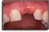 Dental implant uk