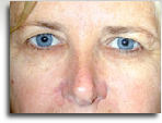 Browlift 1